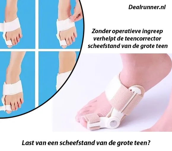Valgus Teencorrector Verhelpt scheefstand van je Grote Teen Pijnloos